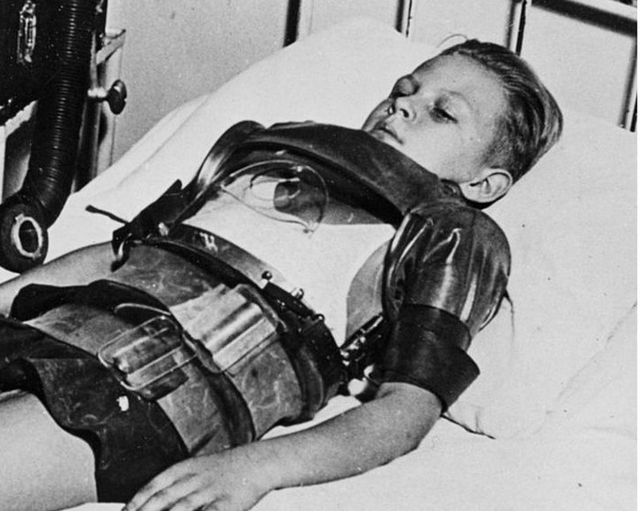 Another kid who had polio